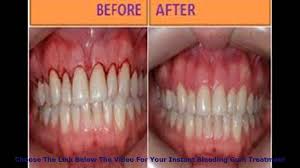 before-and-after-teeth